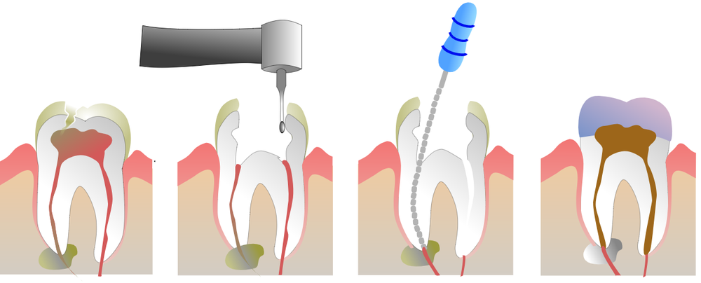 root canal treatment